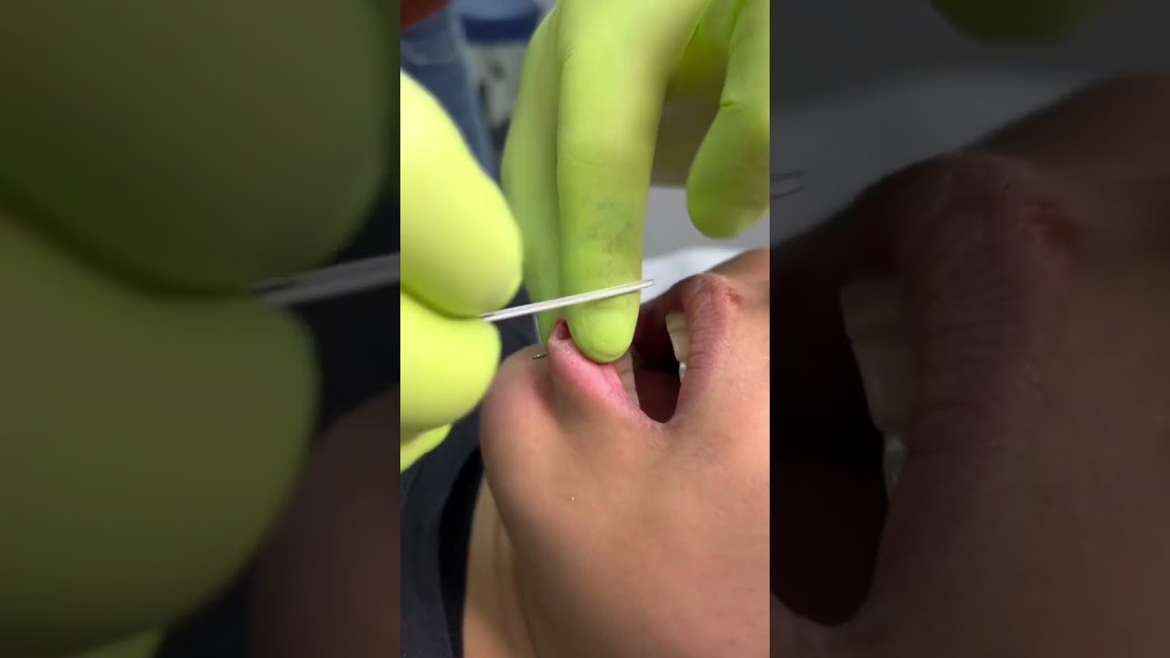 VERTIKALE LABRET