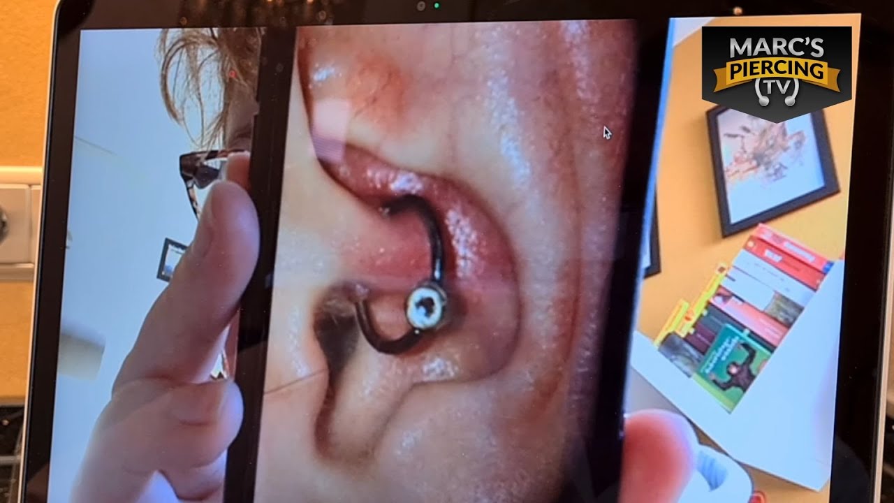 Marc's Piercing Soforthilfe #8 Das entzündete Daith Piercing mit viel Wildfleisch💉Marc's Piercing TV